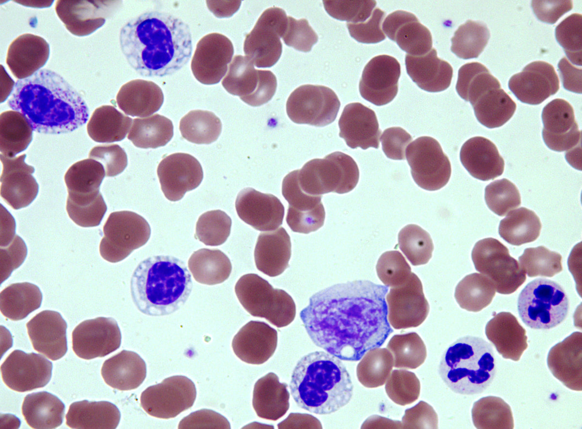 Figure 2. Peripheral blood. Neutrophils demonstrate dysplasia (100x).